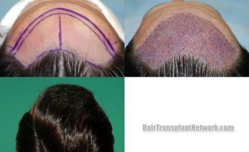 Hair transplantation surgery before and after pictures