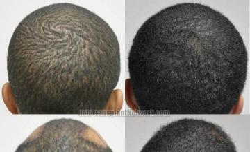 Hair transplantation surgery before and after photos