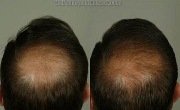 Hair replacement surgery before and after images