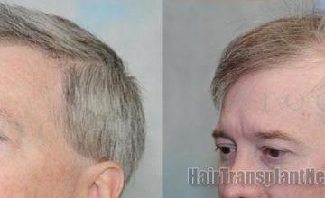 Left view hair transplant postoperative photos