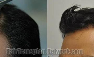 Hair restoration procedure before and after pictures