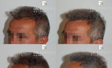 Hair transplantation surgery before and after pictures