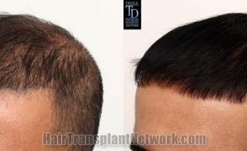 Hair transplantation surgery before and after images