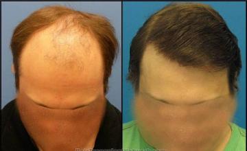 Hair restoration surgery before and after images