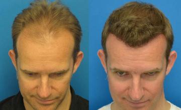 Hair restoration surgery before and after photos