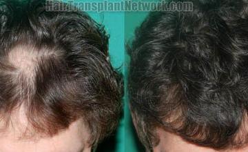 Hair restoration procedure before and after pictures