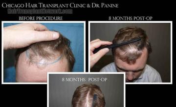 Hair transplantation surgery before and after photos