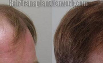 Right view pictures before and after hair transplant procedure