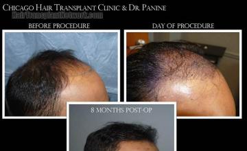 Hair restoration procedure before and after pictures