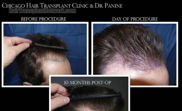 Hair transplantation surgery before and after images