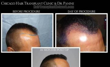 Hair transplantation surgery before and after images