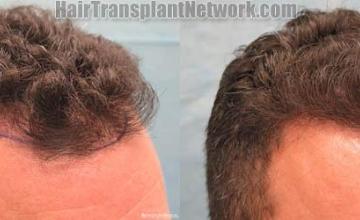 Hair transplantation surgery before and after images