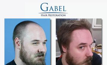 Hair restoration procedure before and after result images