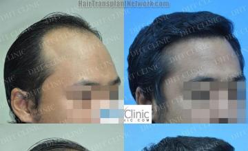 Hair transplantation procedure before and after results