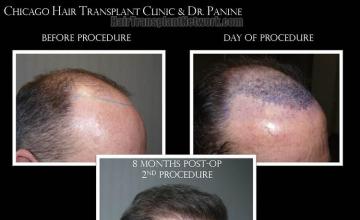 Hair transplantation procedure before and after results