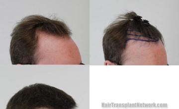 Hair restoration procedure after result images