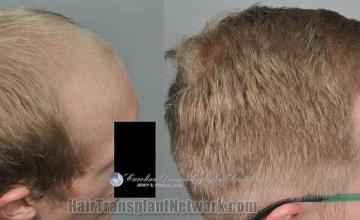 Hair transplantation procedure before and after results