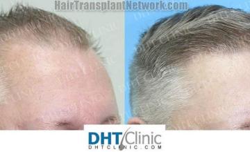 Hair restoration procedure after result images