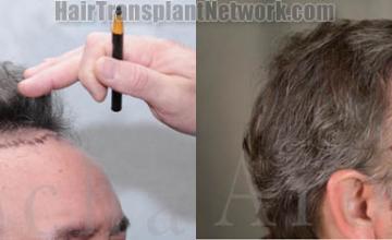 Hair restoration procedure before and after results