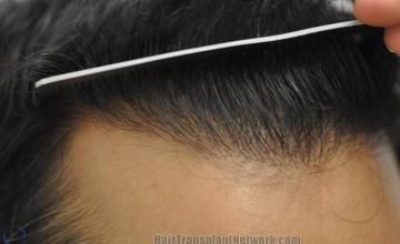 Hair transplant surgery before and after photos