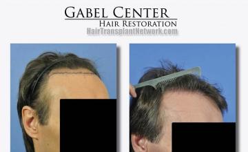 Hair transplant surgery before and after photos