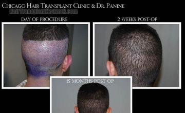 Hair transplantation surgery before and after pictures