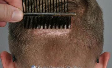 Hair restoration procedure before and after images