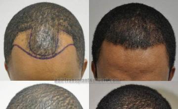 Top view before and after hair restoration results