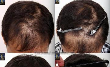 Hair transplantation surgery before and after photos