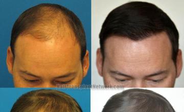 Hair transplantation surgery before and after photos