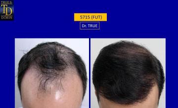 Hair transplantation surgery before and after photos