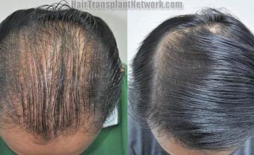 Hair transplantation surgery before and after photos