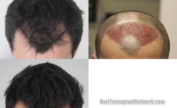 Top view before and after hair restoration results