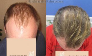 Hair restoration procedure before and after results