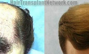 Hair transplantation surgery before and after photos