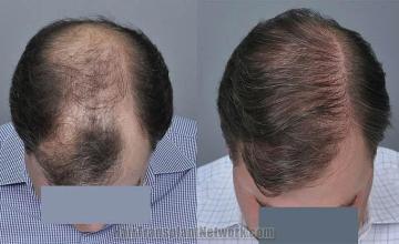 Hair restoration procedure before and after results