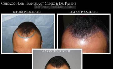 Hair restoration procedure before and after result photos