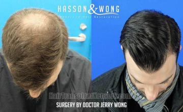 Hair transplantation surgery before and after images