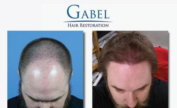 Top view - Before and after hair restoration procedure