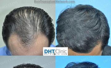 Hair transplantation surgery before and after images