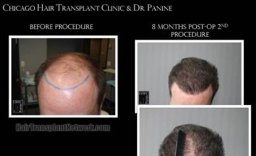 Hair transplantation surgery before and after images