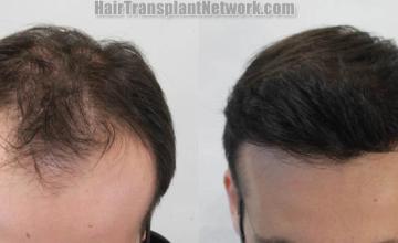 Before and after hair restoration procedure images