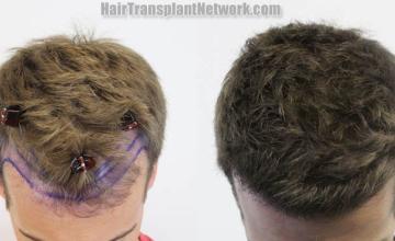 Hair transplantation surgery before and after images