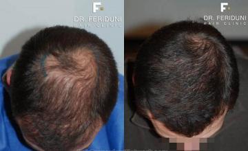 Hair restoration surgery before and after images