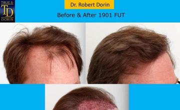 Hair transplantation surgery before and after pictures