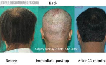 Surgical hair transplantation result photographs