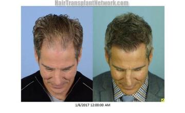 Hair restoration procedure before and after photo results