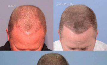 Hair restoration surgery before and after photos