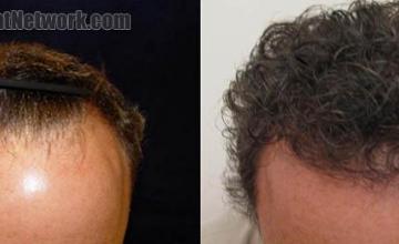 Before and after hair transplantation procedure images