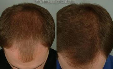 Hair transplantation surgery before and after images